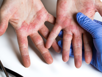 Kožným ekzémom na Slovensku trpí okolo 5% populácie, z toho takmer polovica atopickou dermatitídou. Horšie na tom je výskyt plesne na nechtoch (hubová infekcia nechtov), ktorá postihuje až 12% ľudí.