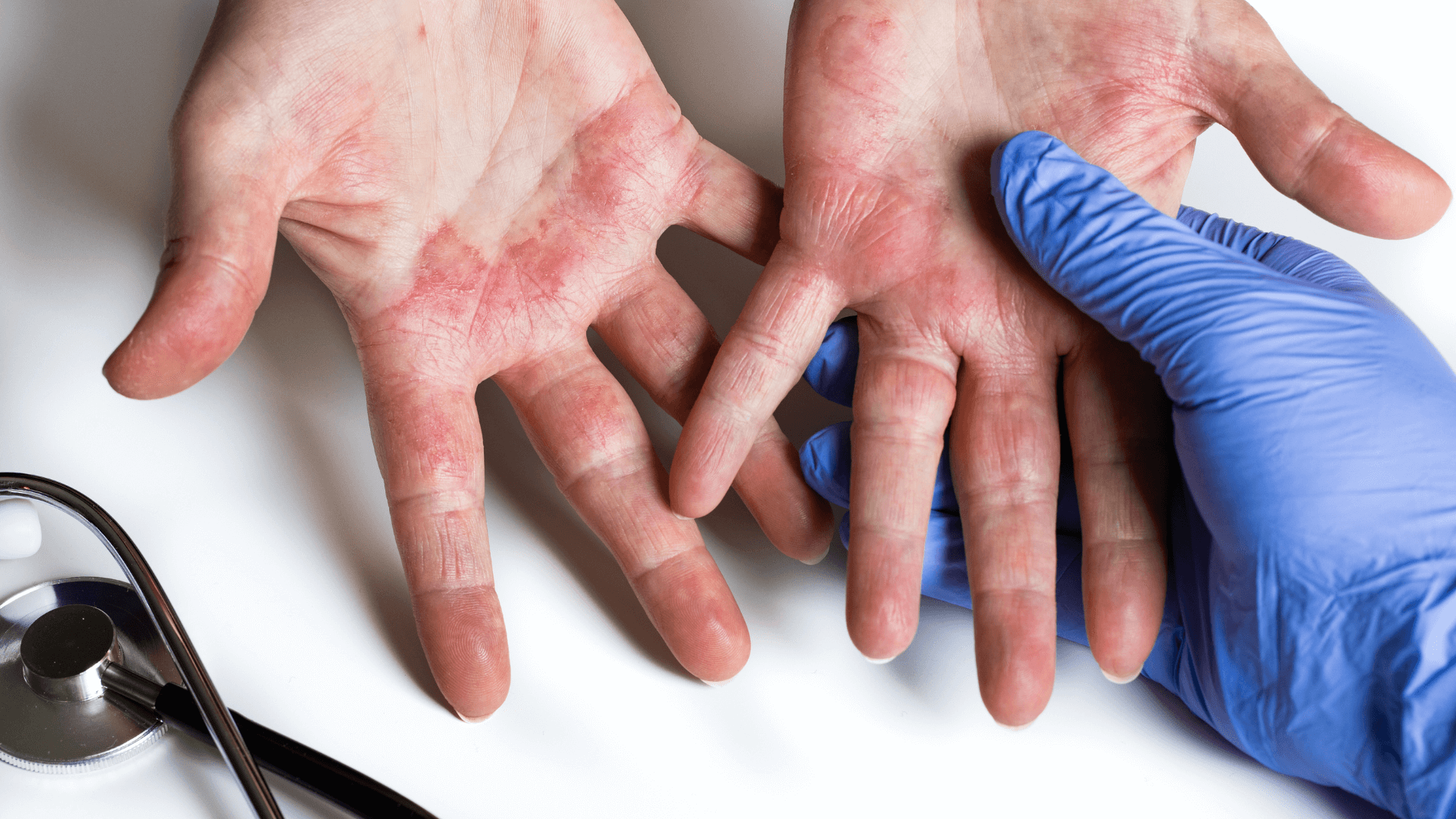 Kožným ekzémom na Slovensku trpí okolo 5% populácie, z toho takmer polovica atopickou dermatitídou. Horšie na tom je výskyt plesne na nechtoch (hubová infekcia nechtov), ktorá postihuje až 12% ľudí.