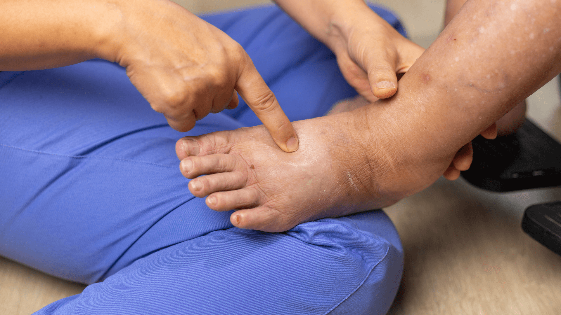 Diabetická noha patrí medzi najčastejšie a najzávažnejšie komplikácie cukrovky.